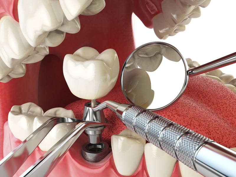 Top 5 Reasons to Get Dental Implants
